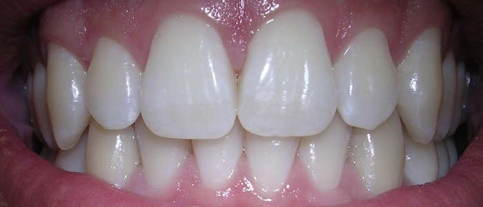 Карієс можна запобігти за допомогою гелю, що відновлює зубну емаль