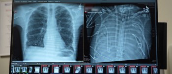 Штучні легені підтримували життя чоловіка до пересадки