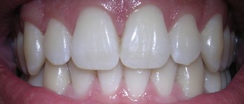 Карієс можна запобігти за допомогою гелю, що відновлює зубну емаль