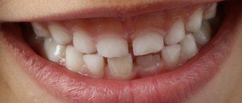 Вчені збираються протестувати ліки для вирощування нових зубів